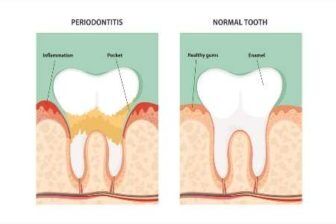 Periodontal Treatment Costs With & Without Insurance